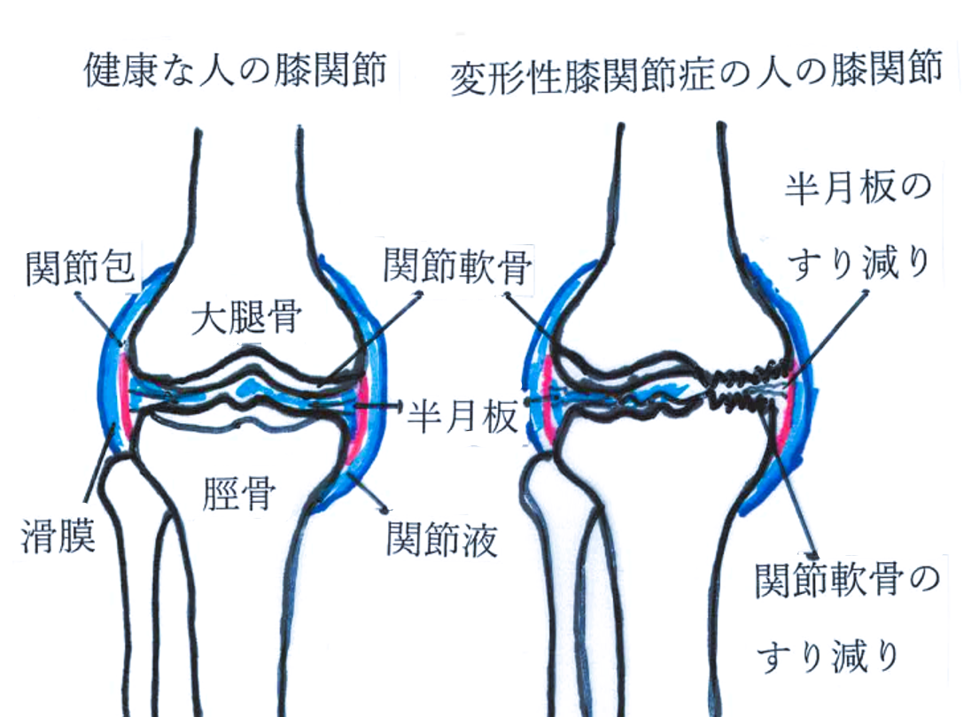 変形性膝関節症(第1回) ひとら整形外科リハビリクリニックブログ